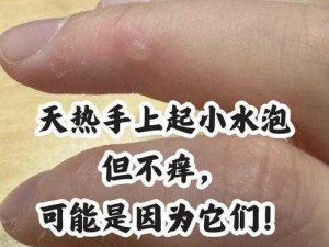 手指痒一抓就破出水怎么回事—手指痒一抓就破出水，可能是这些原因